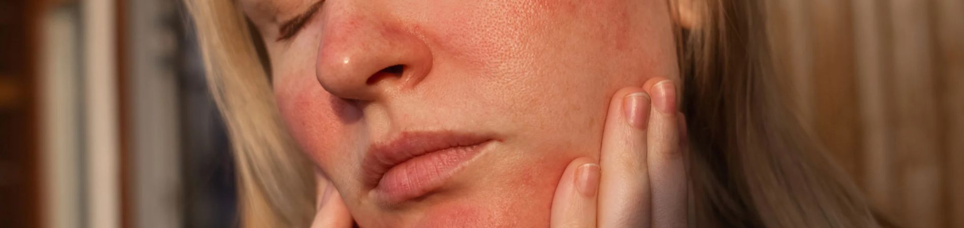 Vrouw met rosacea