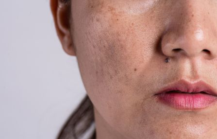 Wat is de beste manier om pigmentvlekken te behandelen?