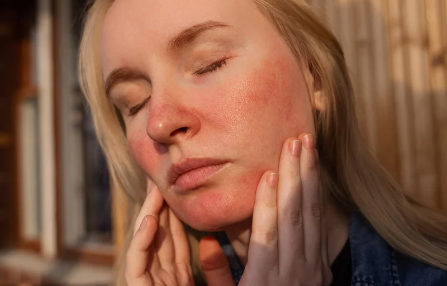 Rosacea: zo verzorg je een gevoelige, snel rode huid